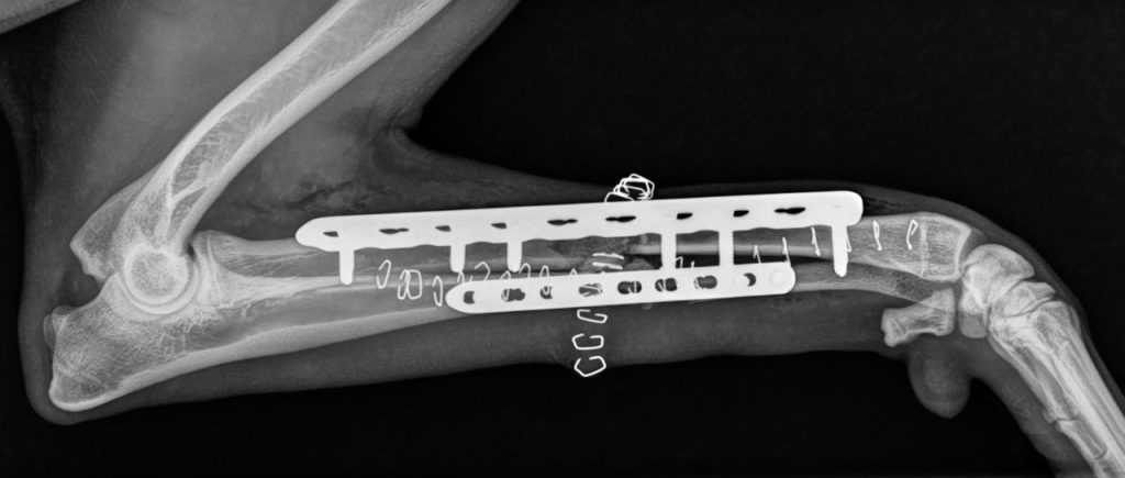 Fratura rádio e ulna